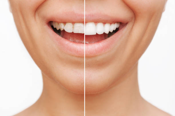 photo showing the before and after of teeth with veneers