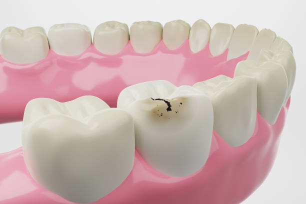 a dental illustration of a decayed teeth