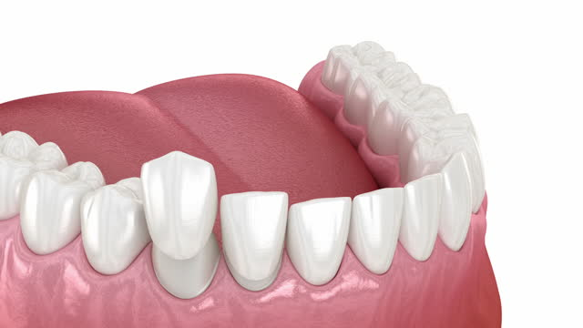 a digital image showing how veneers are put on the teeth