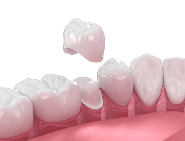 image showing the placement of a dental crown